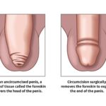 Kennedy Sets the Record Straight on Circumcision, Autism, and Tylenol Controversies