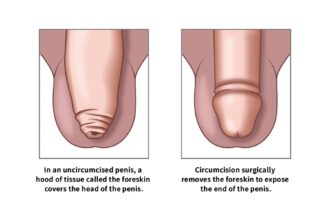 Kennedy Sets the Record Straight on Circumcision, Autism, and Tylenol Controversies