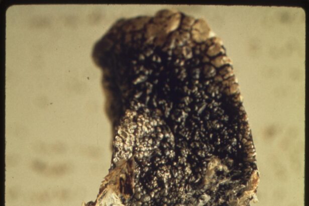 Is Black Lung Still a Death Sentence for America’s Coal Miners? Examining Trump’s Response